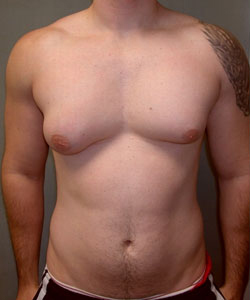 1429711494-Gynecomast-o.jpg
