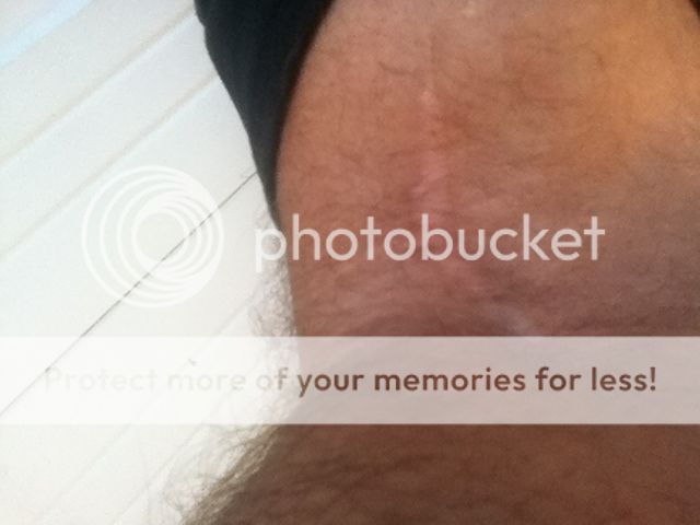 bicep%20scar.jpg